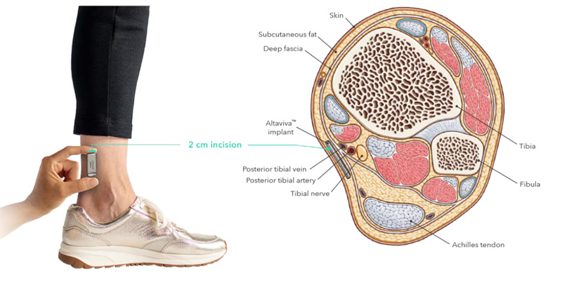 Trinity Health Michigan successfully completed the state’s first implant of a device that helps treat urge urinary incontinence. The device is placed in the patient’s ankle and transmits comfortable electrical pulses to the tibial nerve, helping regulate communication between the bladder and the brain to help restore proper bladder function.